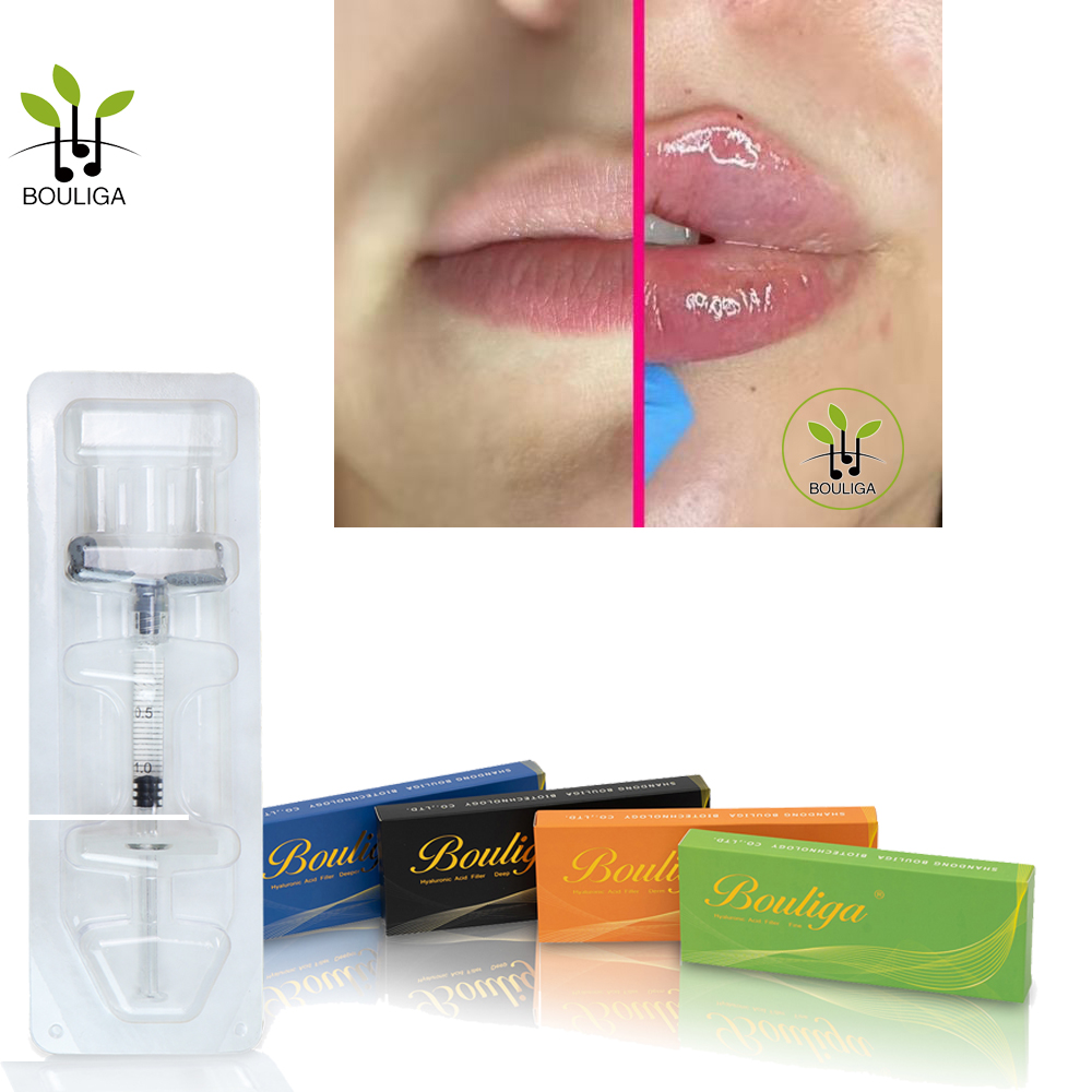 Bouliga Lip Plumper 1 מ'ל 2 מ'ל 5 מ'ל מילוי עור